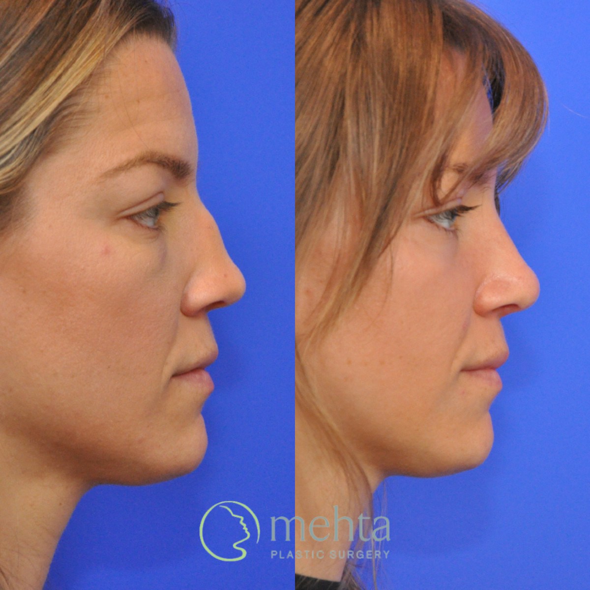 Rhinoplasty Before & After Gallery - Patient 373707 - Image 6
