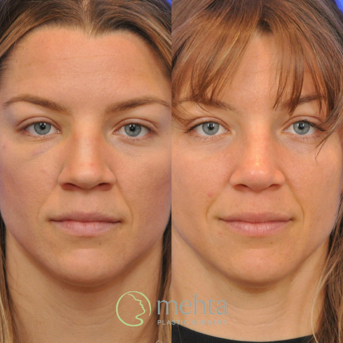Rhinoplasty Before & After Gallery - Patient 373707 - Image 3