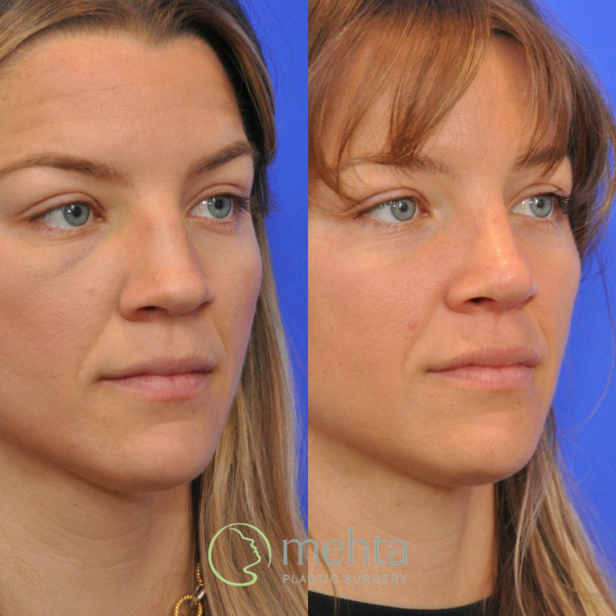 Rhinoplasty Before & After Gallery - Patient 373707 - Image 5