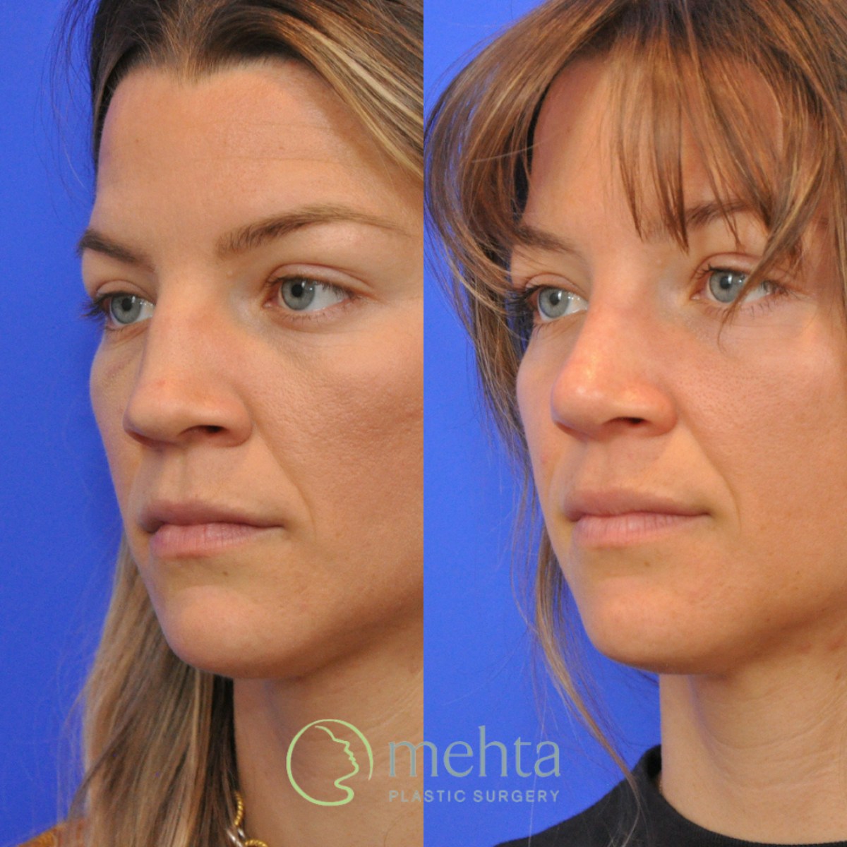 Rhinoplasty Before & After Gallery - Patient 373707 - Image 2
