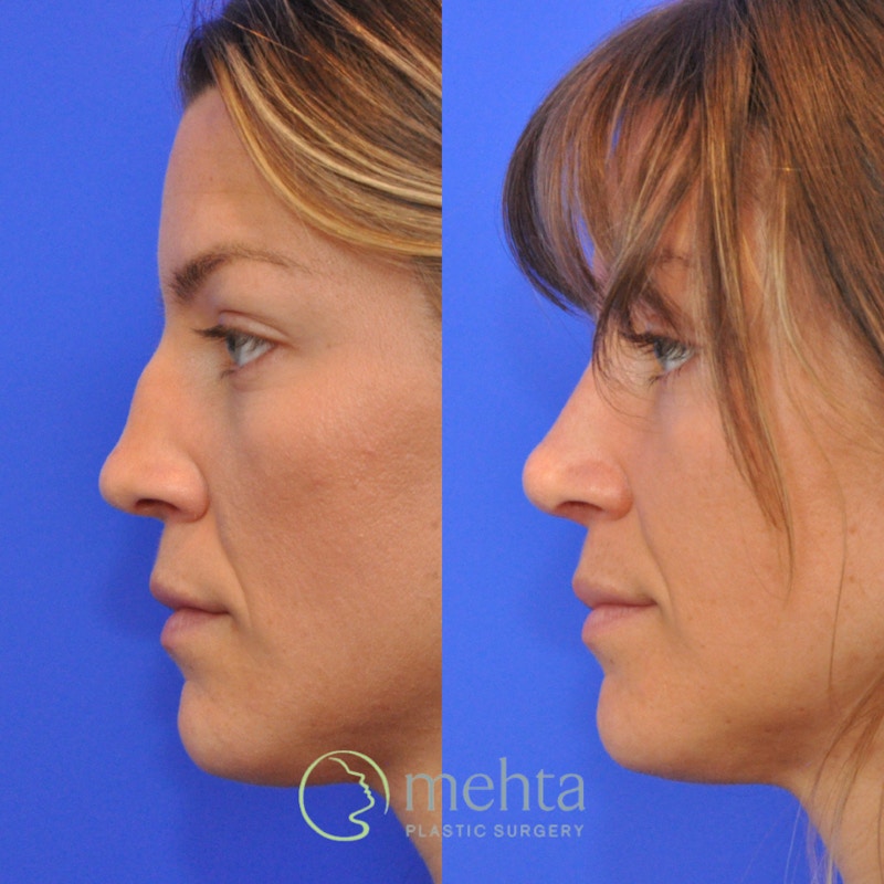 Rhinoplasty Before & After Gallery - Patient 373707 - Image 1