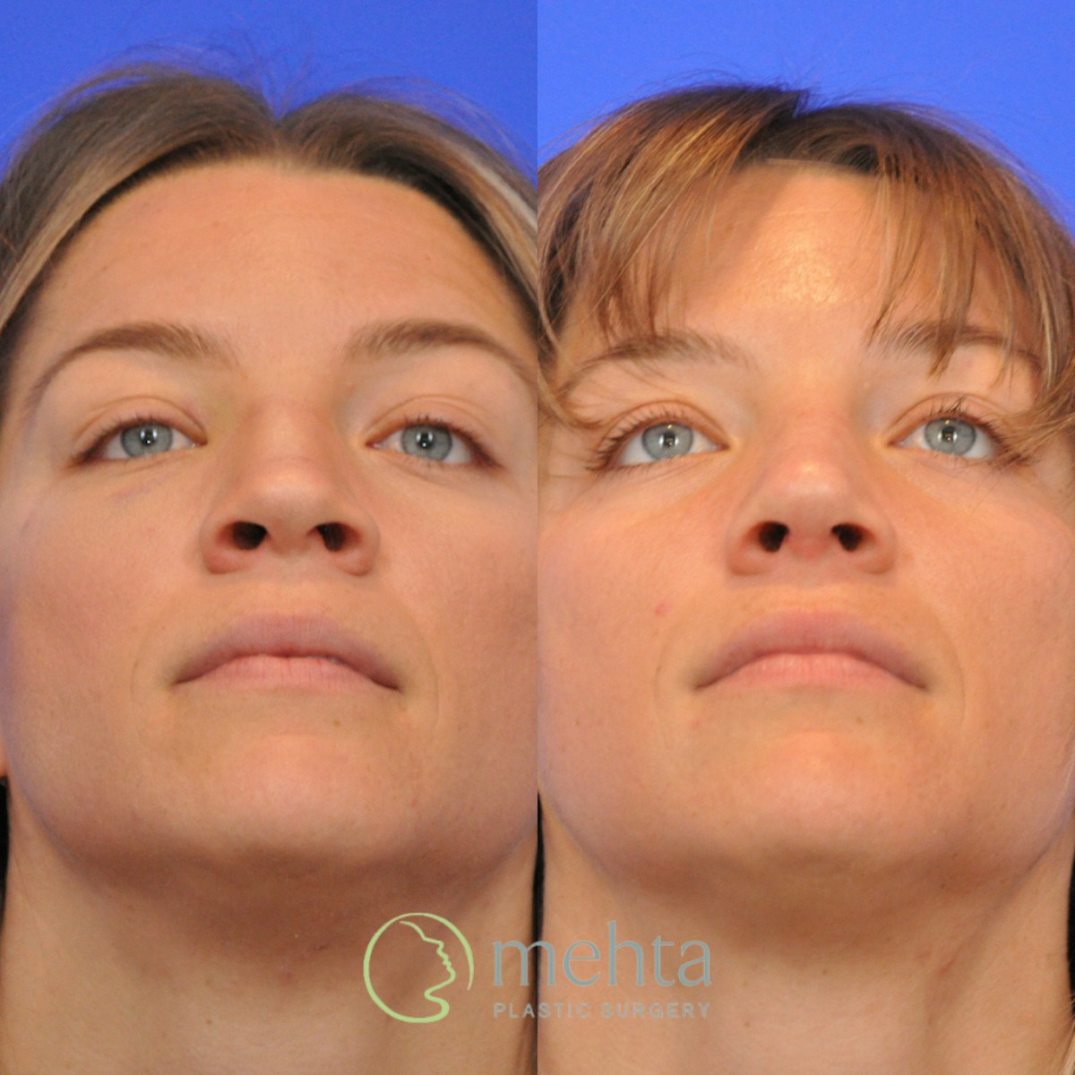 Rhinoplasty Before & After Gallery - Patient 373707 - Image 4