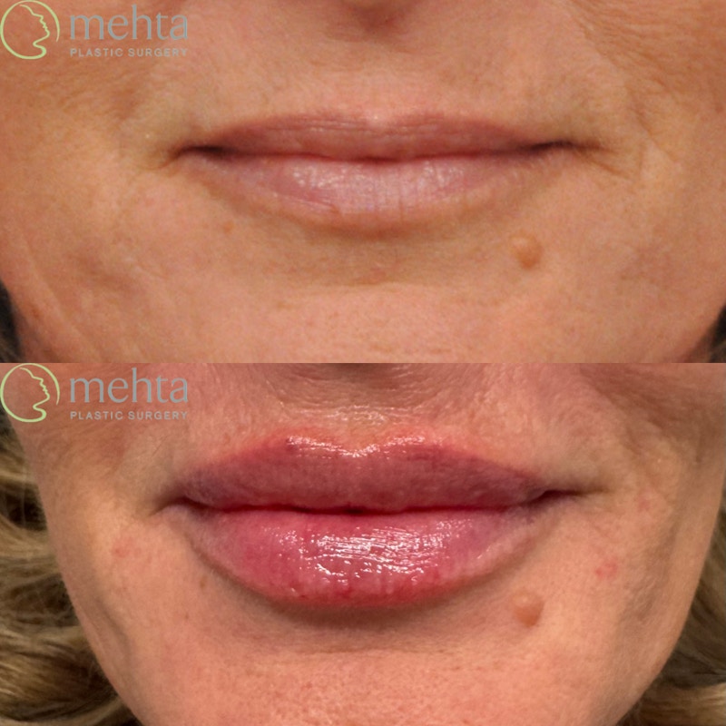 Lip Augmentation Before & After Gallery - Patient 217436 - Image 1