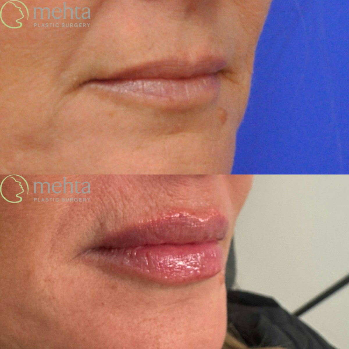 Lip Augmentation Before & After Gallery - Patient 217436 - Image 2