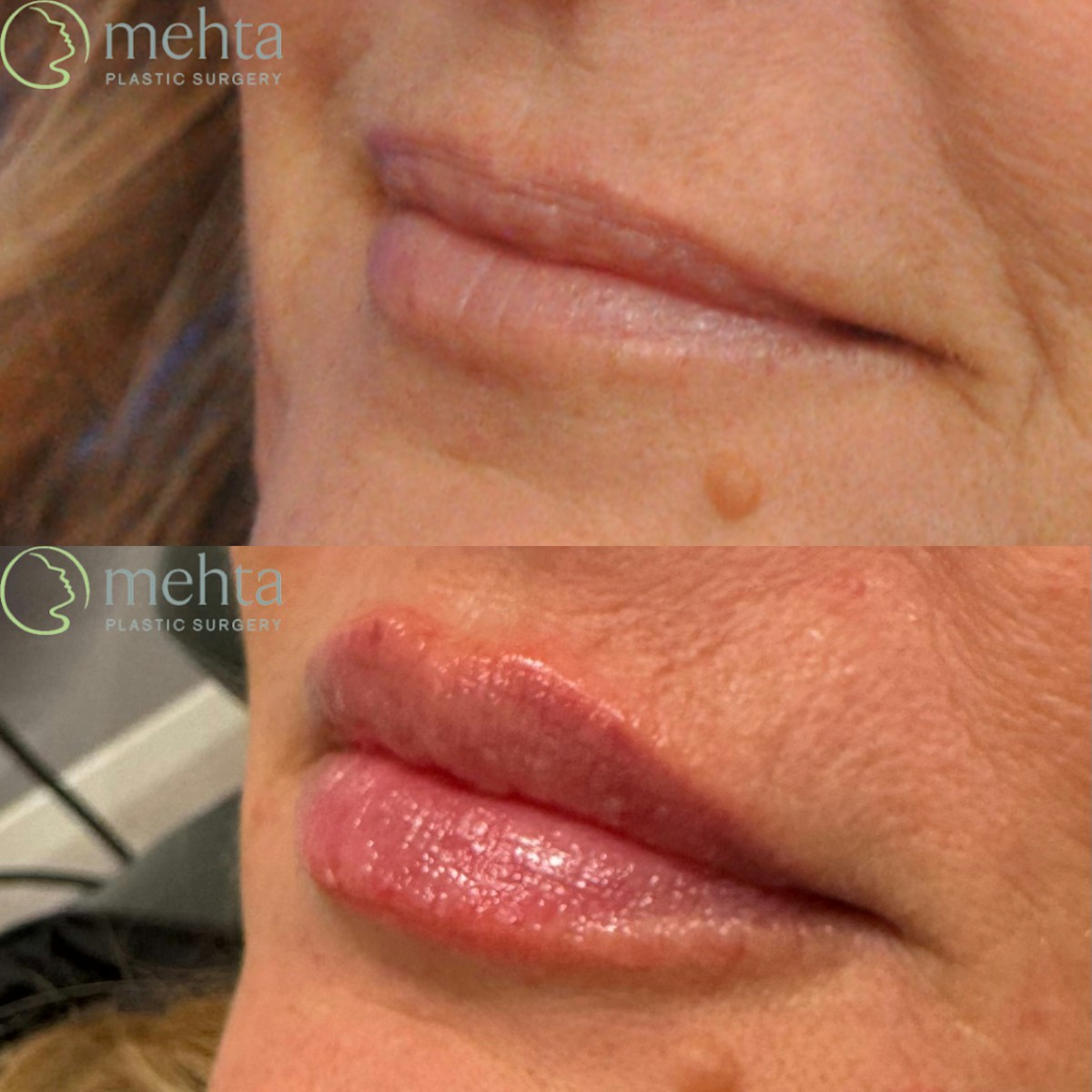 Lip Augmentation Before & After Gallery - Patient 217436 - Image 3