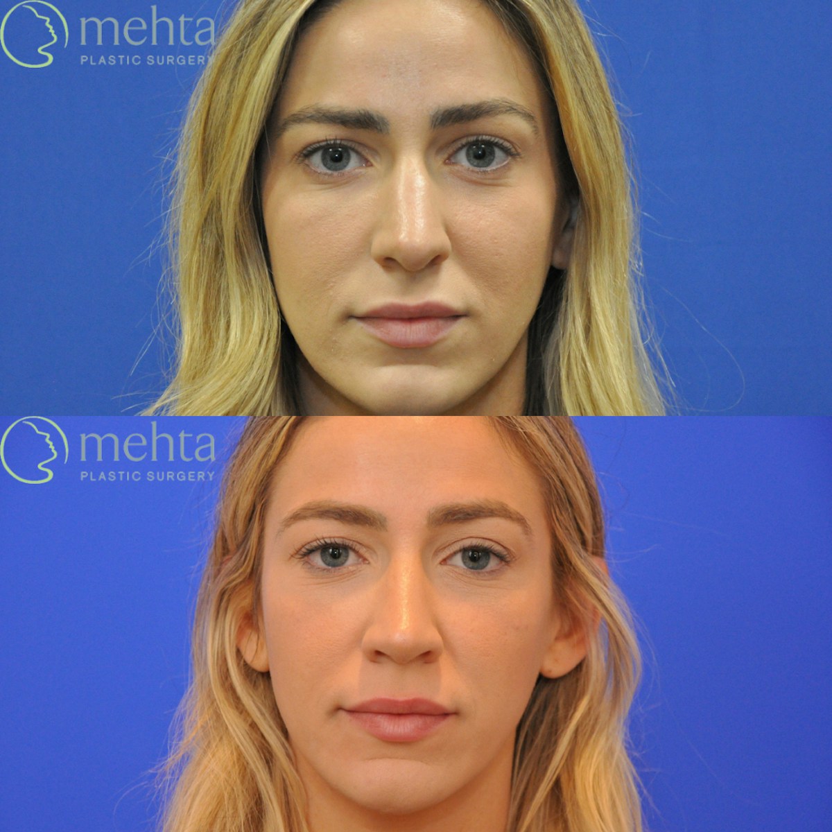 Revision Rhinoplasty Before & After Gallery - Patient 136996 - Image 3