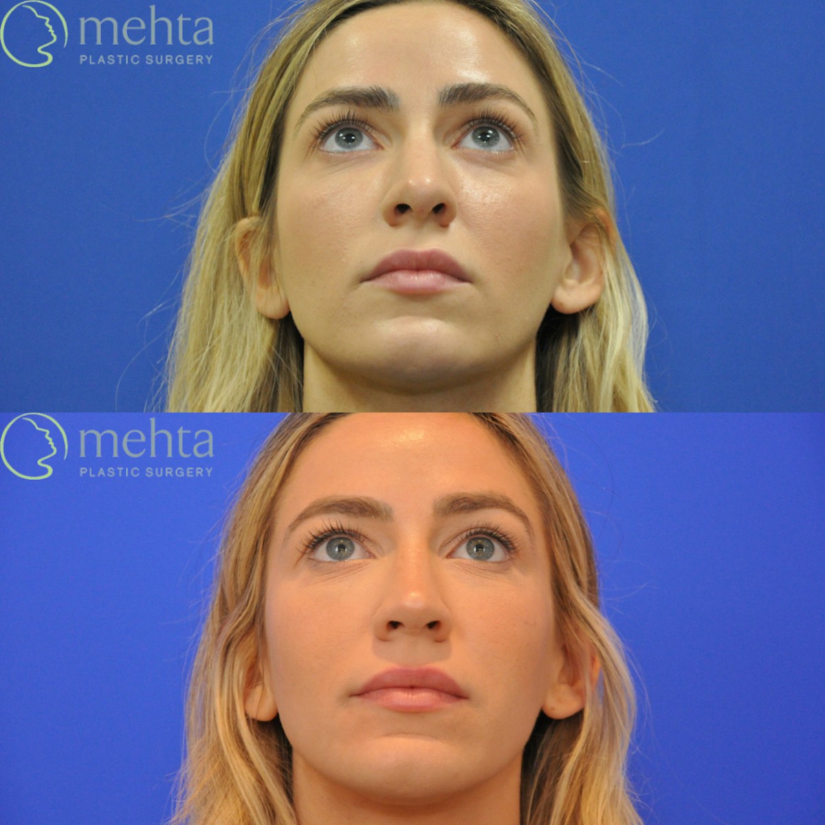 Revision Rhinoplasty Before & After Gallery - Patient 136996 - Image 4