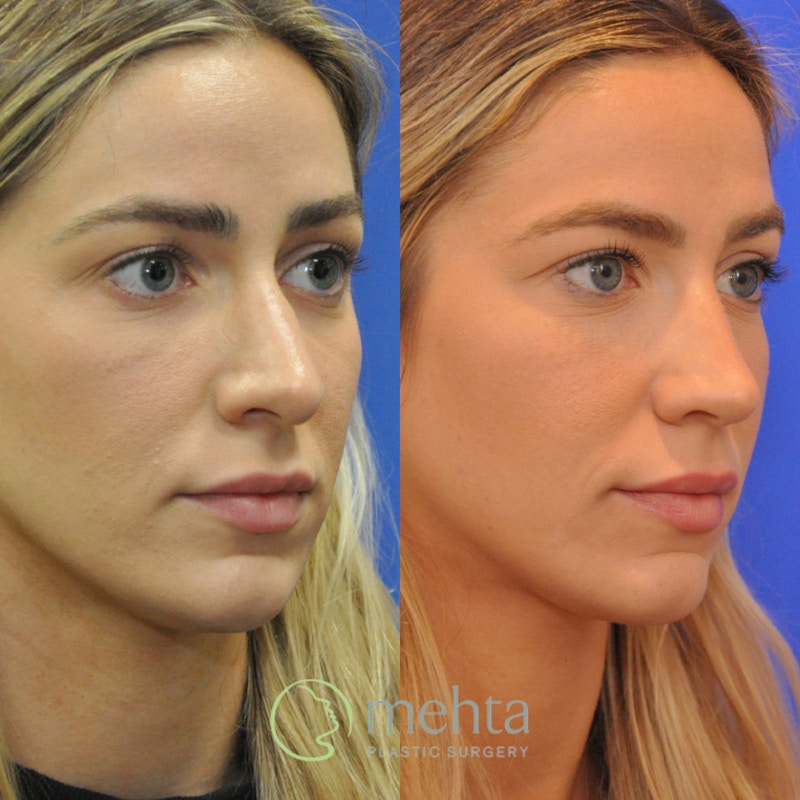 Revision Rhinoplasty Before & After Gallery - Patient 136996 - Image 1