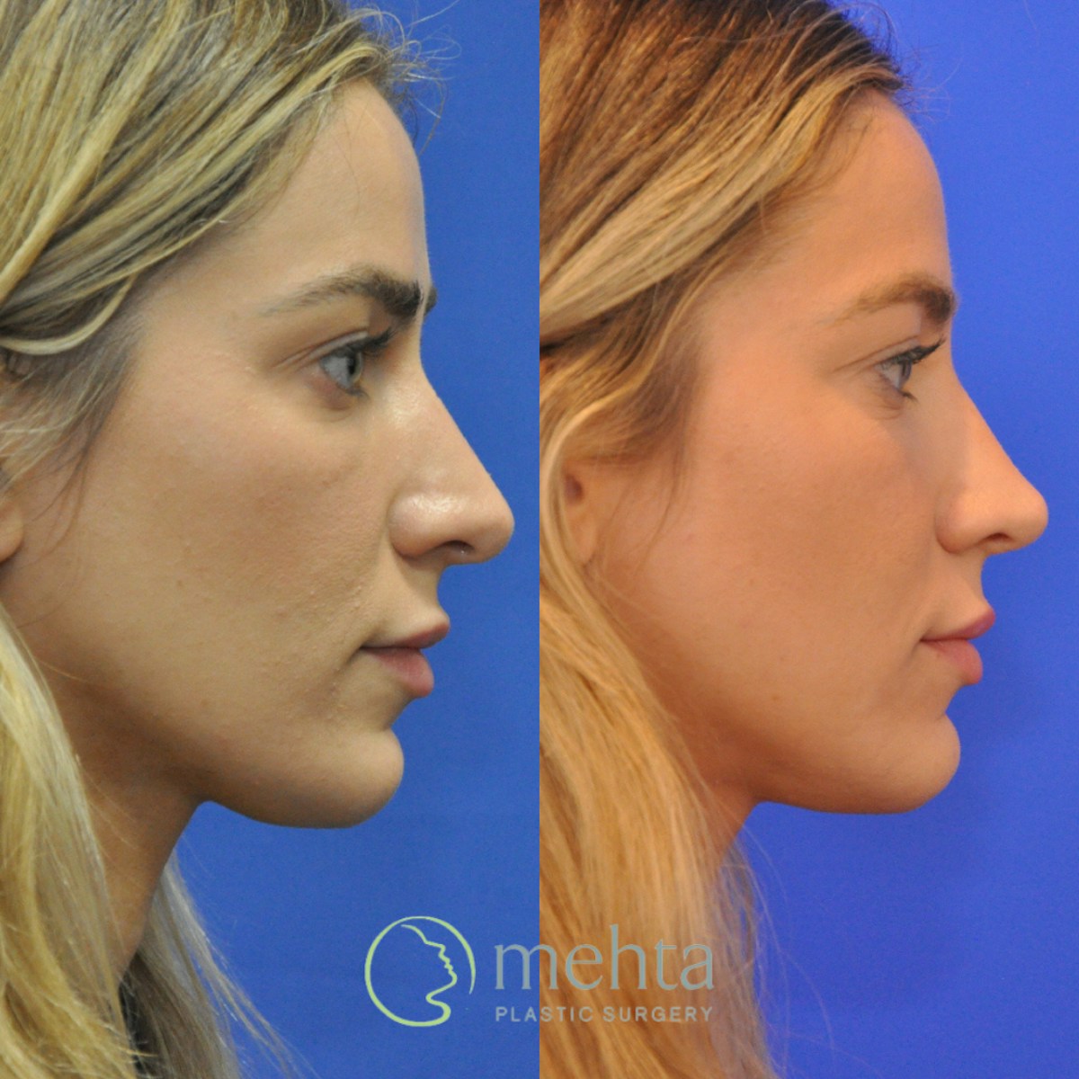 Revision Rhinoplasty Before & After Gallery - Patient 136996 - Image 2