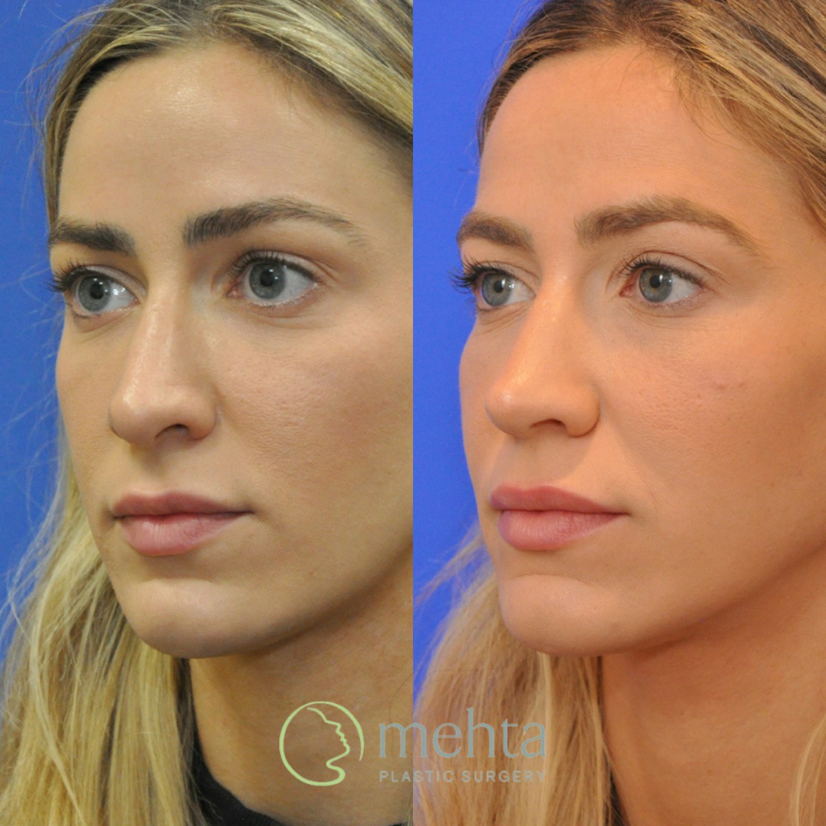 Revision Rhinoplasty Before & After Gallery - Patient 136996 - Image 5