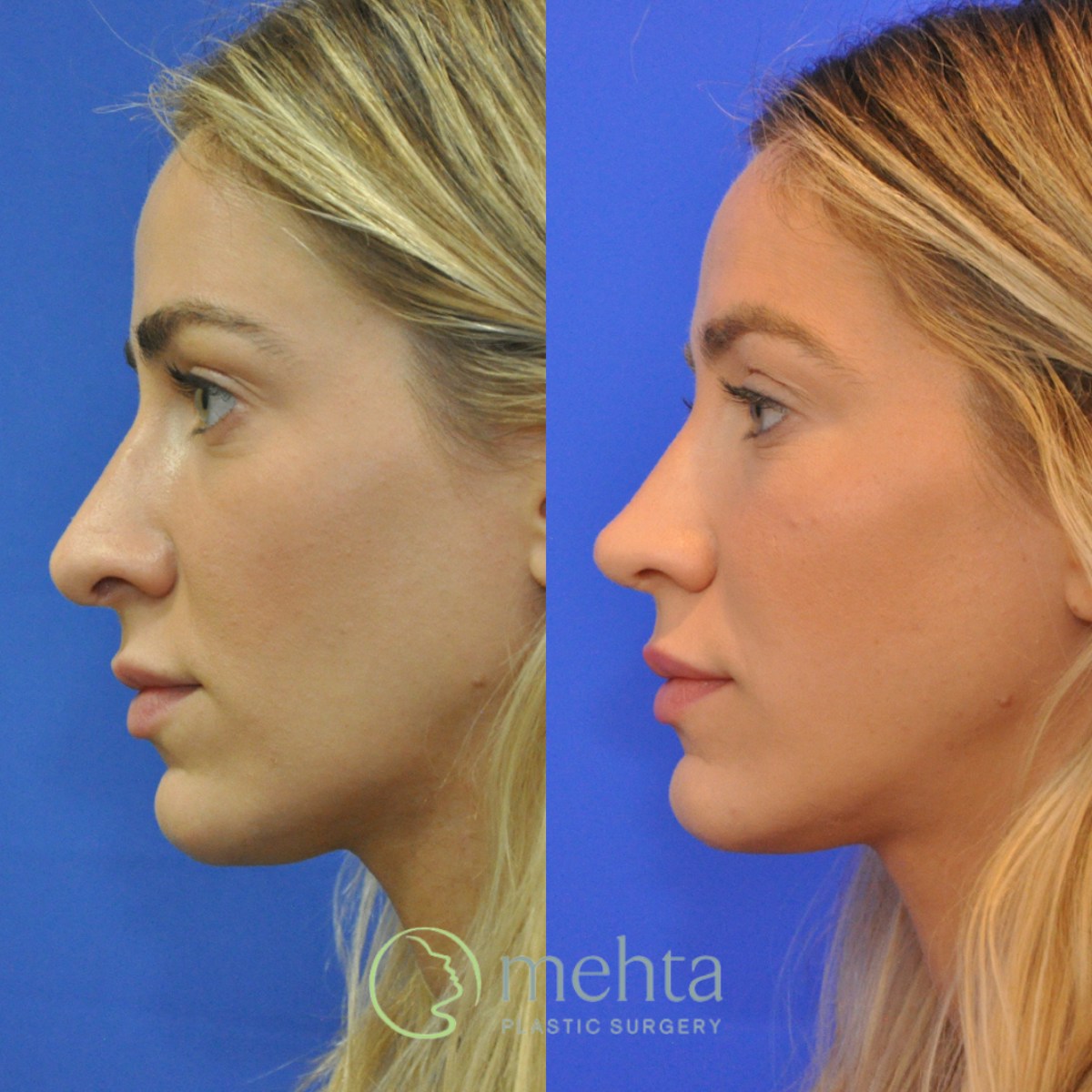 Revision Rhinoplasty Before & After Gallery - Patient 136996 - Image 6