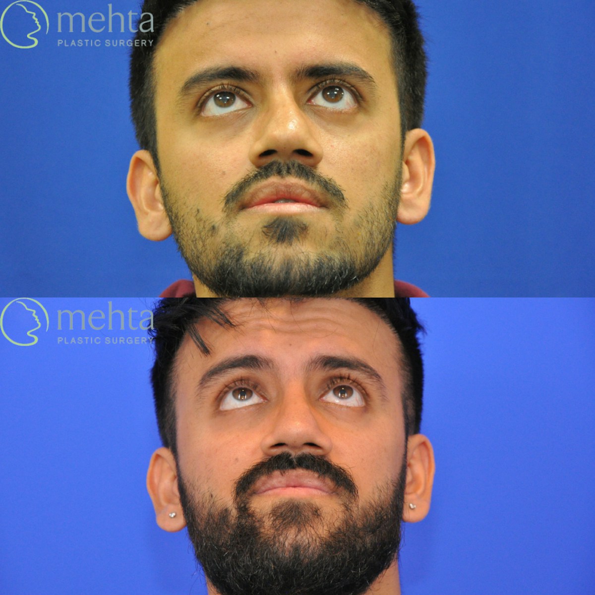 Revision Rhinoplasty Before & After Gallery - Patient 138926 - Image 4