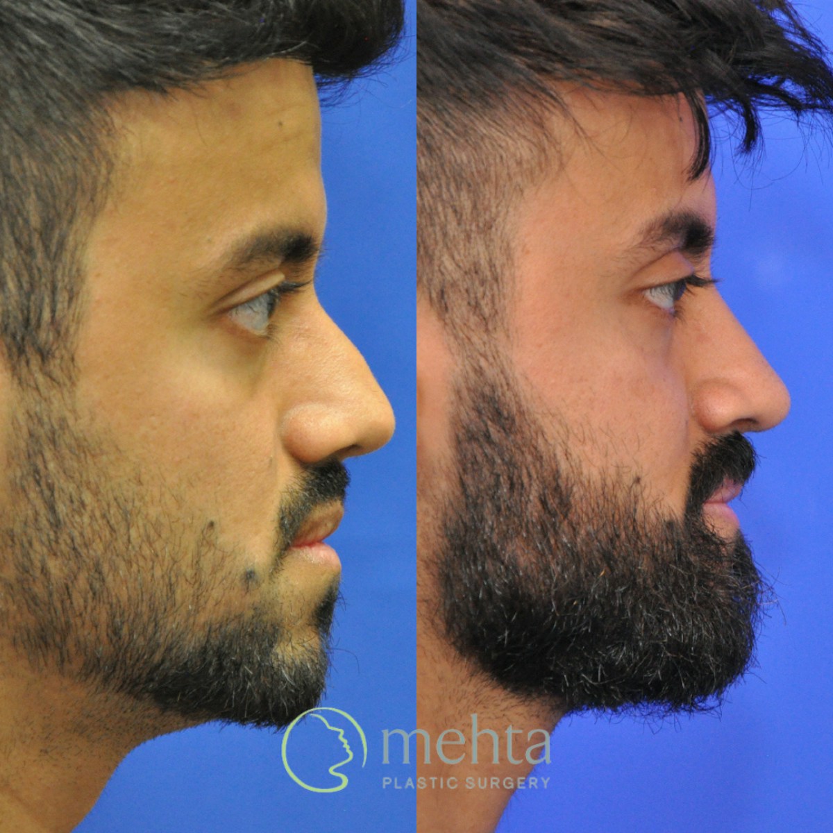 Revision Rhinoplasty Before & After Gallery - Patient 138926 - Image 2
