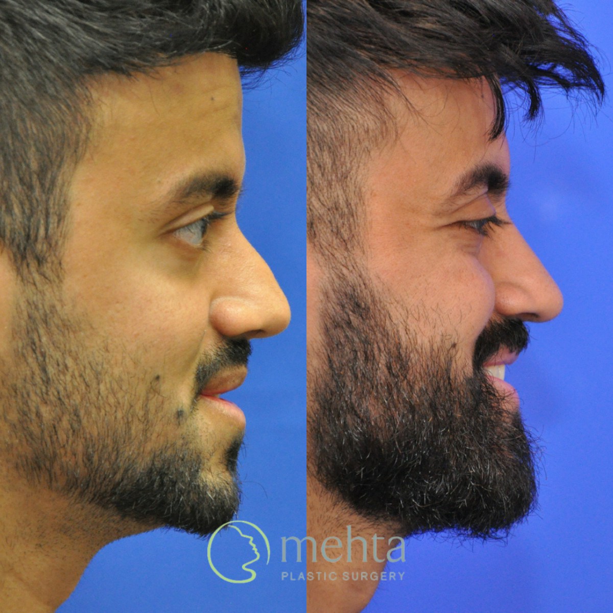 Revision Rhinoplasty Before & After Gallery - Patient 138926 - Image 5
