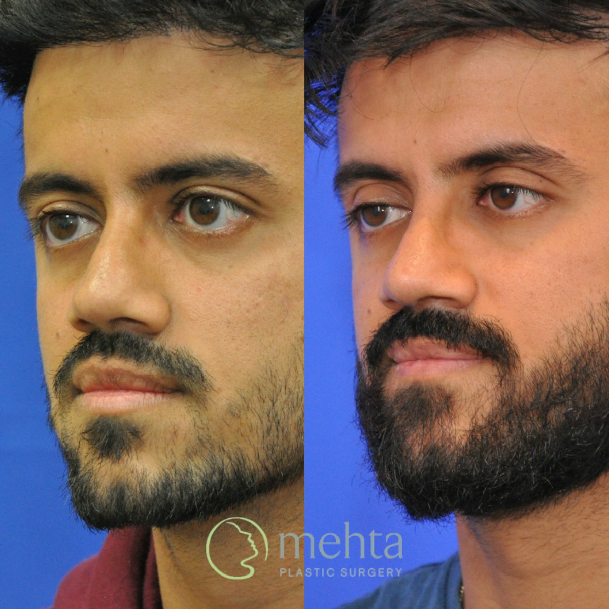 Revision Rhinoplasty Before & After Gallery - Patient 138926 - Image 6