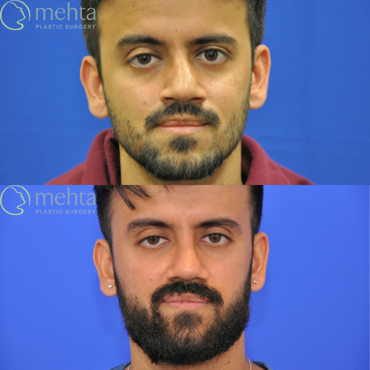Revision Rhinoplasty Before & After Gallery - Patient 138926 - Image 3