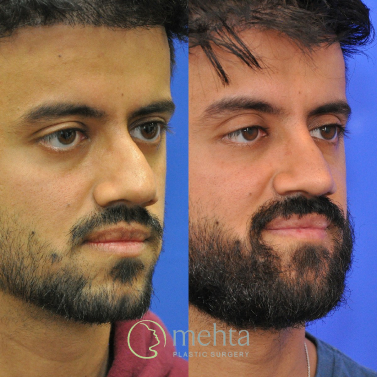 Revision Rhinoplasty Before & After Gallery - Patient 138926 - Image 1
