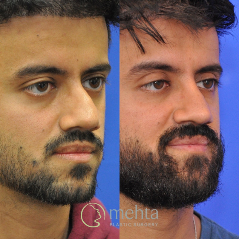 Revision Rhinoplasty Before & After Gallery - Patient 138926 - Image 1