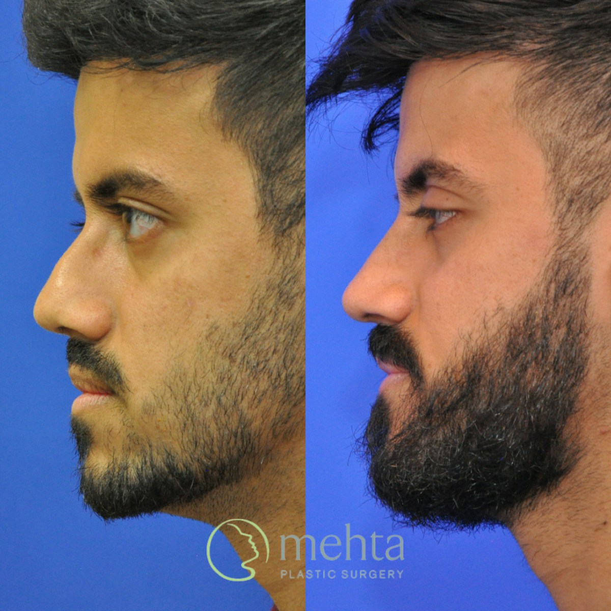 Revision Rhinoplasty Before & After Gallery - Patient 138926 - Image 7
