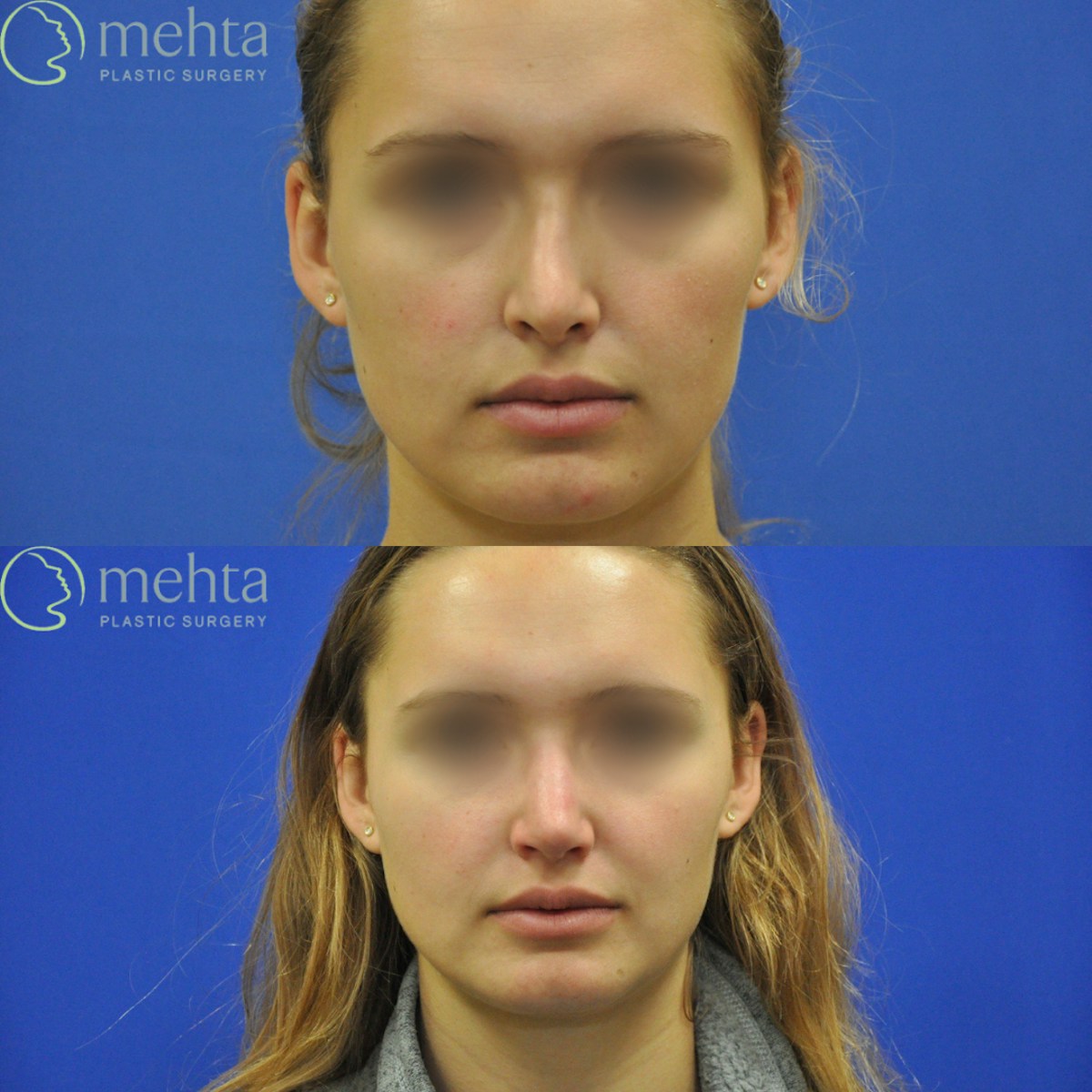 Revision Rhinoplasty Before & After Gallery - Patient 311868 - Image 2
