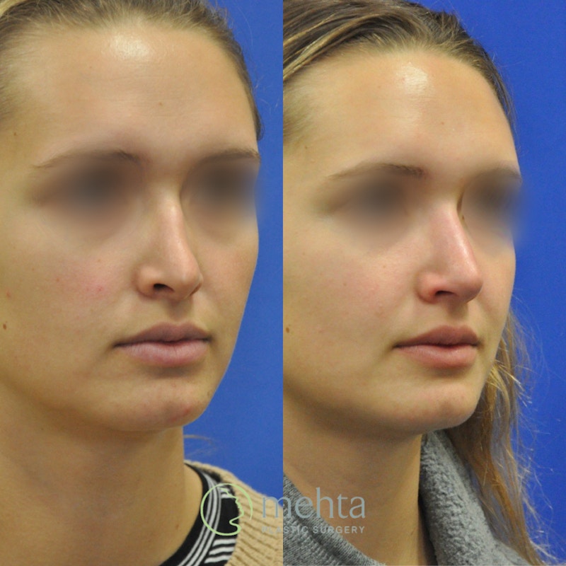 Revision Rhinoplasty Before & After Gallery - Patient 311868 - Image 1
