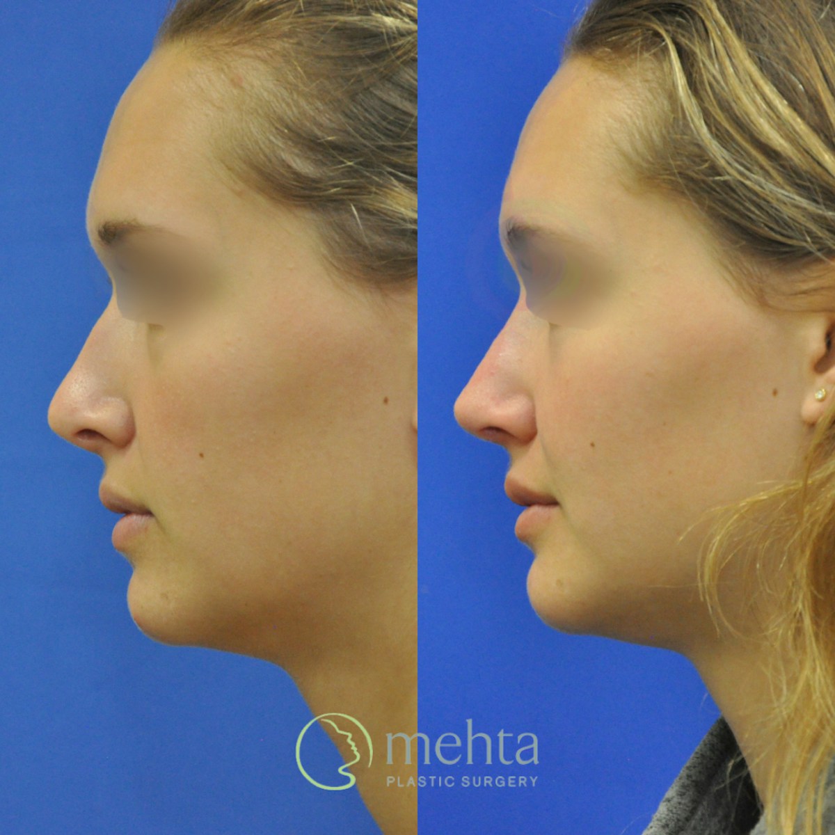Revision Rhinoplasty Before & After Gallery - Patient 311868 - Image 4