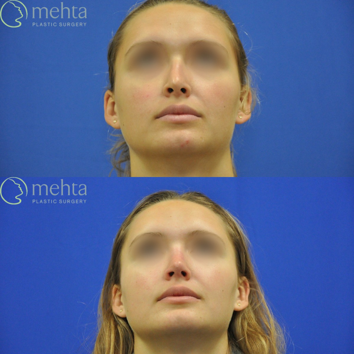 Revision Rhinoplasty Before & After Gallery - Patient 311868 - Image 3