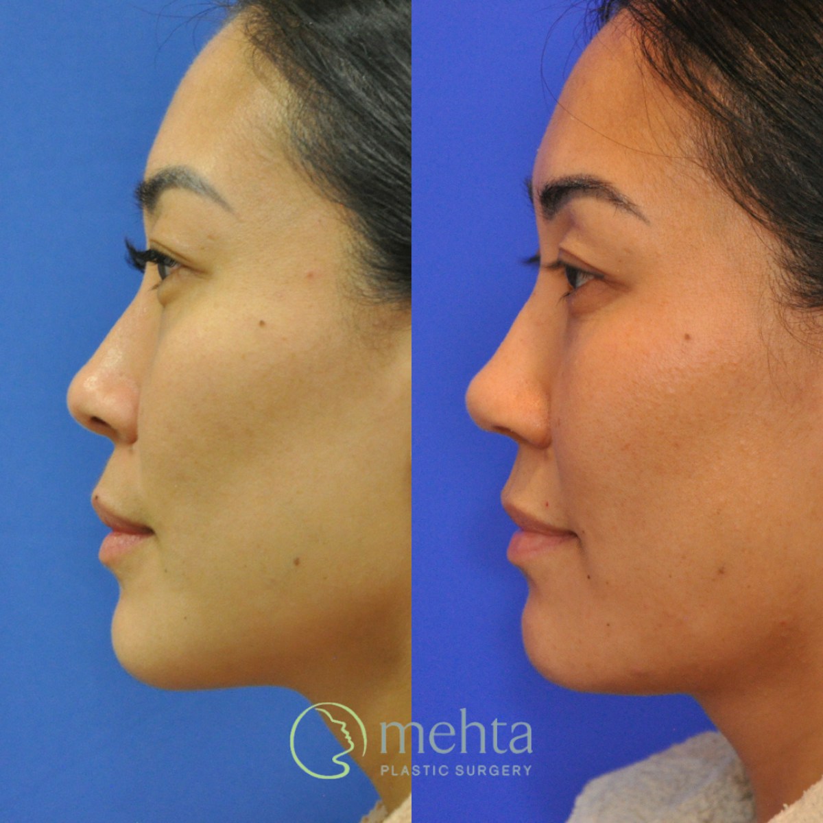 Rhinoplasty Before & After Gallery - Patient 380204 - Image 1
