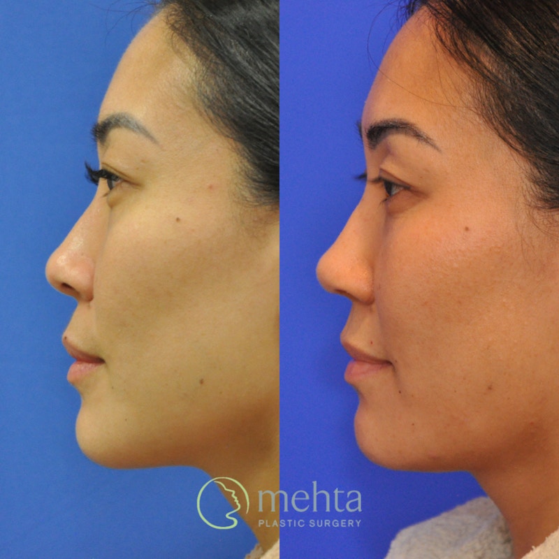 Rhinoplasty Before & After Gallery - Patient 380204 - Image 1