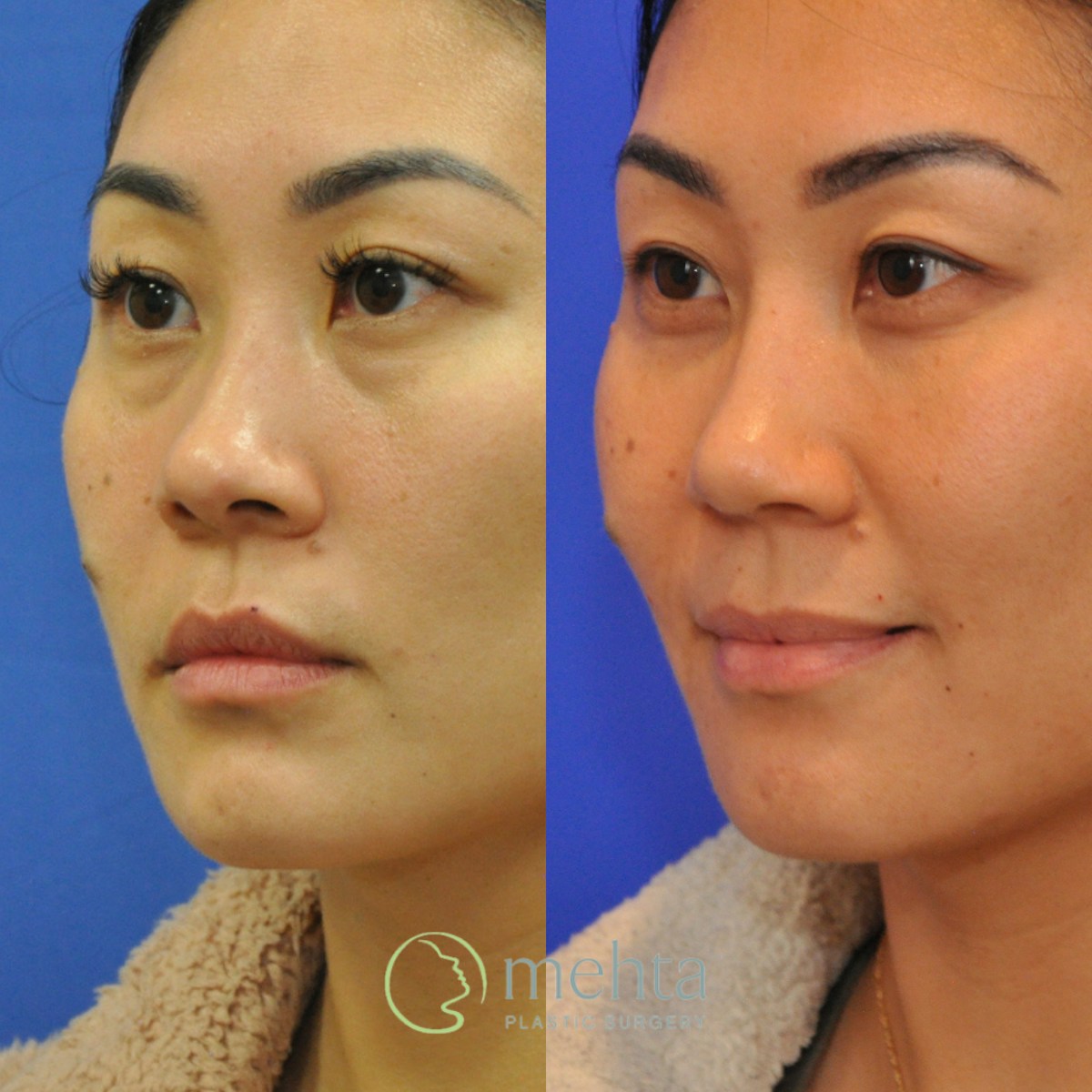 Rhinoplasty Before & After Gallery - Patient 380204 - Image 2