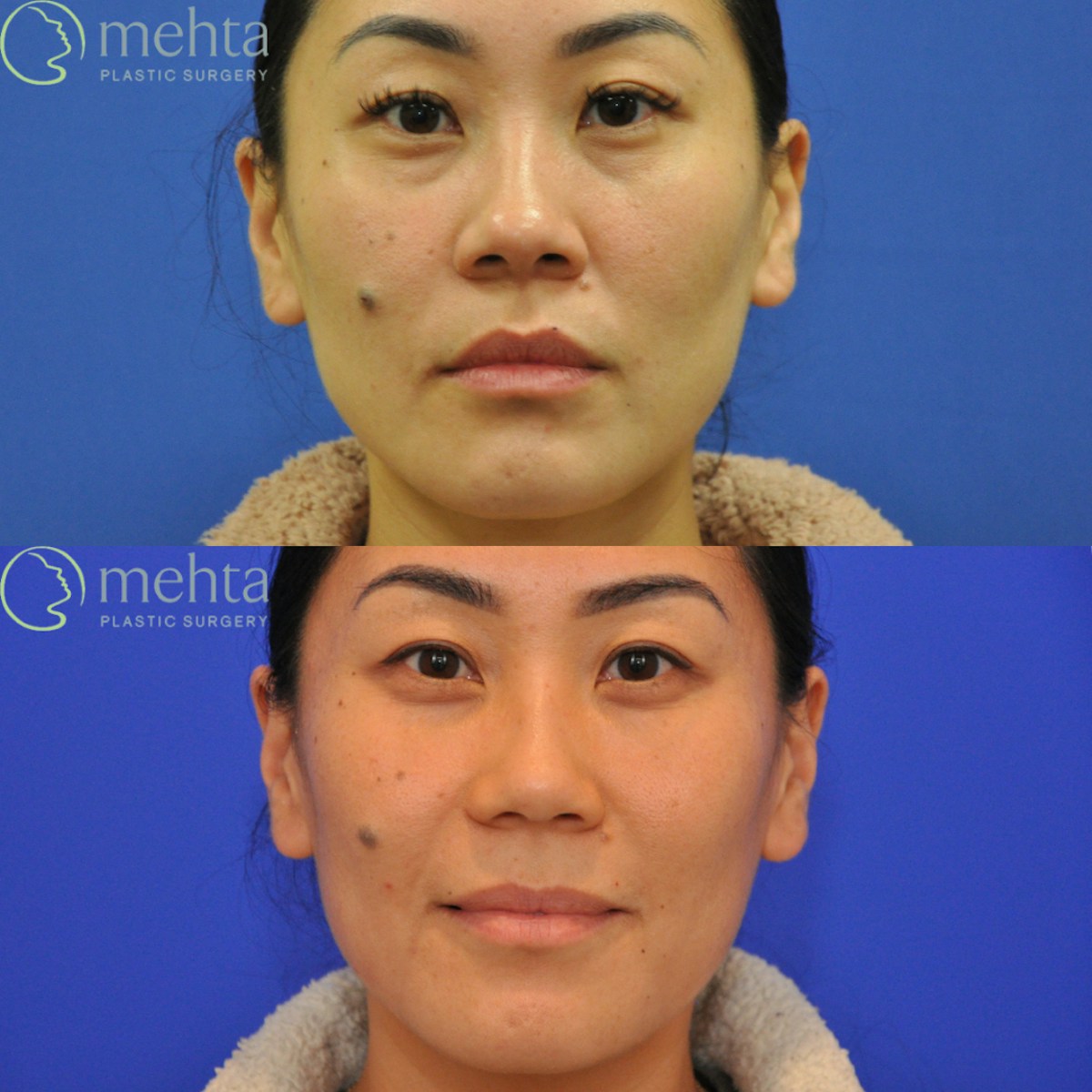 Rhinoplasty Before & After Gallery - Patient 380204 - Image 4