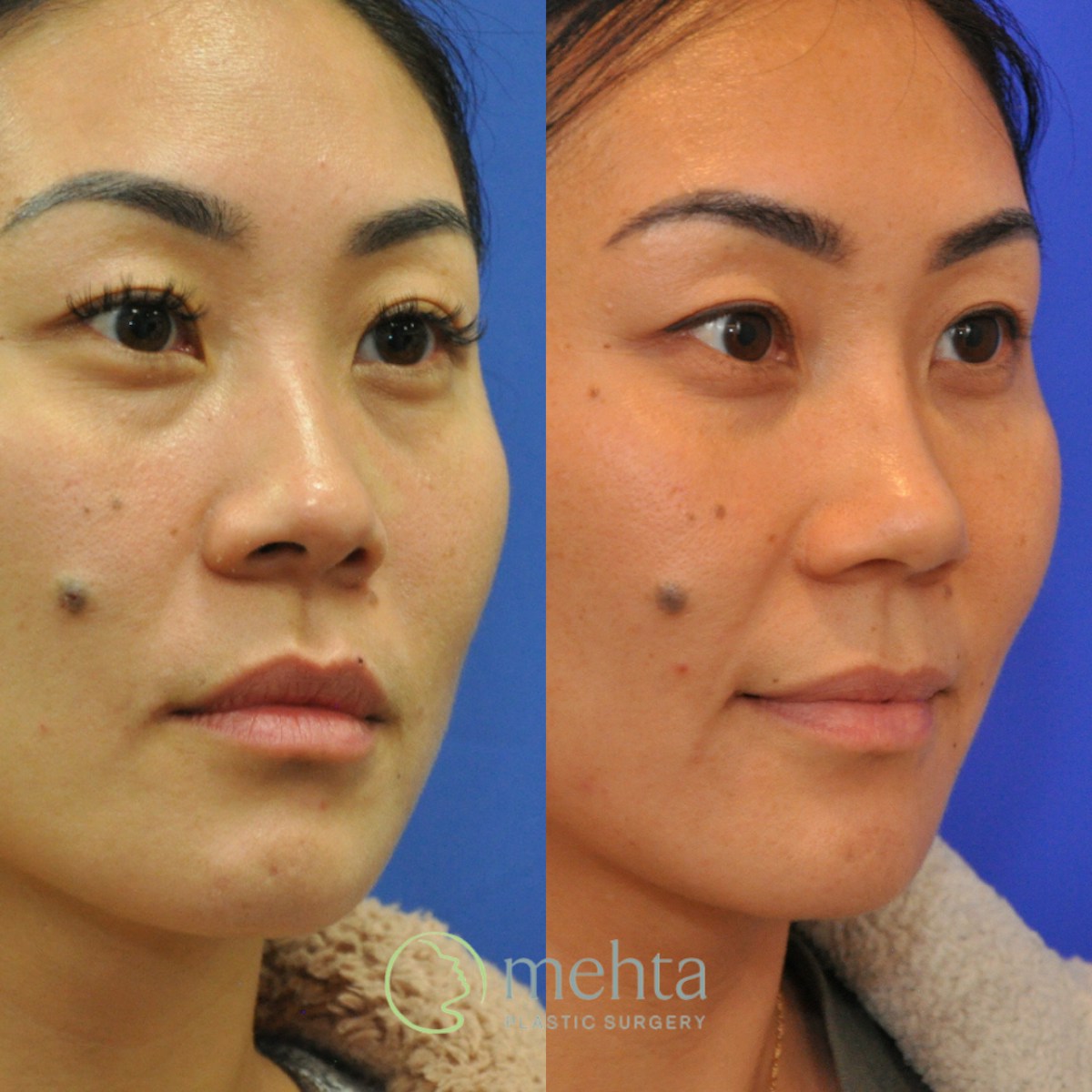 Rhinoplasty Before & After Gallery - Patient 380204 - Image 3
