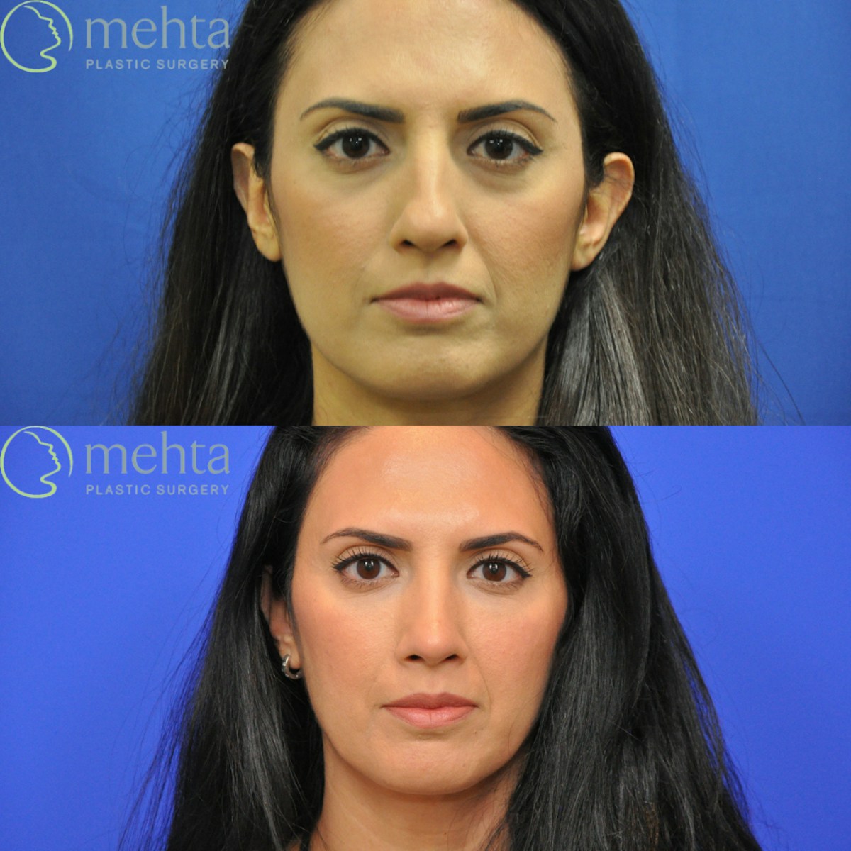 Rhinoplasty Before & After Gallery - Patient 920754 - Image 3