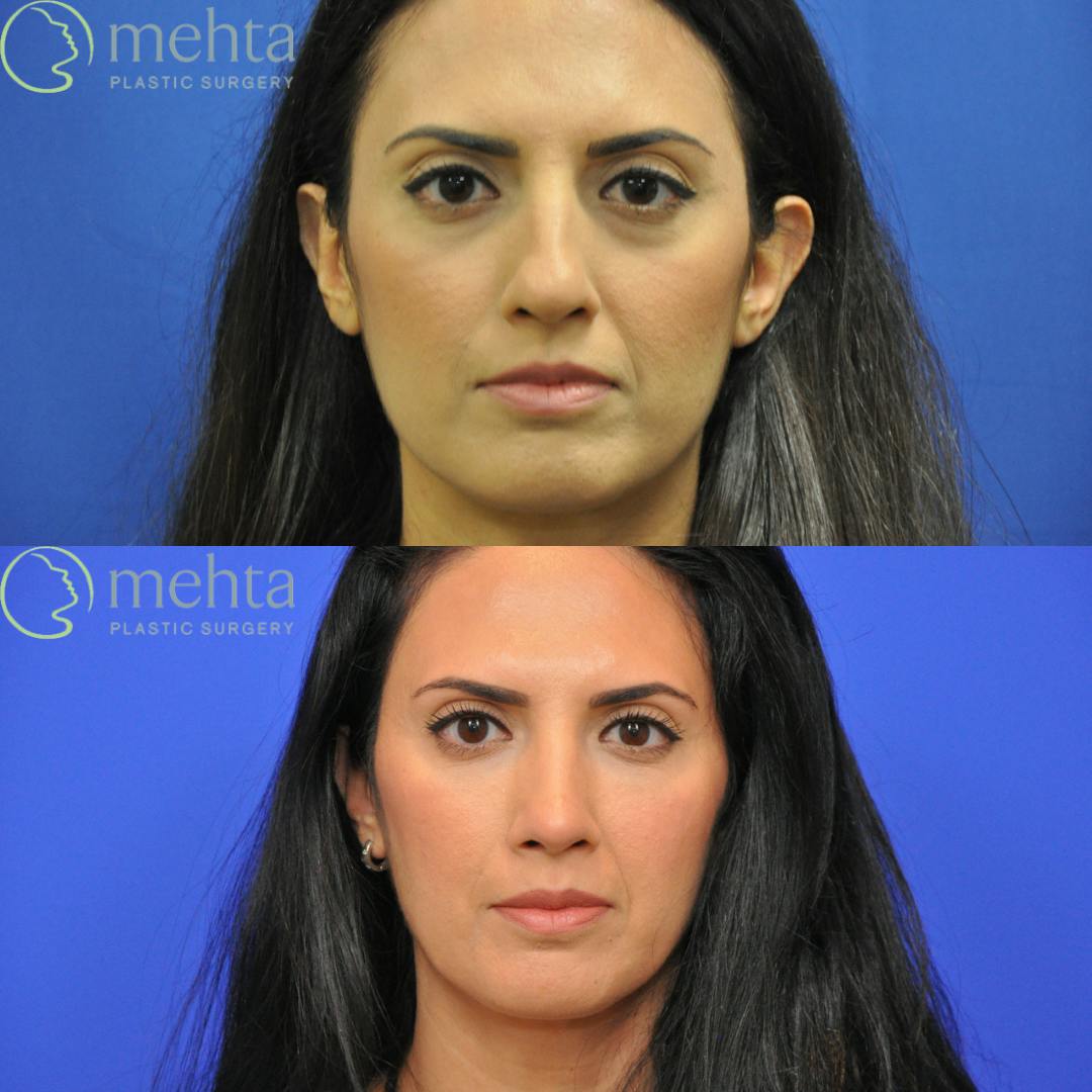Rhinoplasty Before & After Gallery - Patient 920754 - Image 3