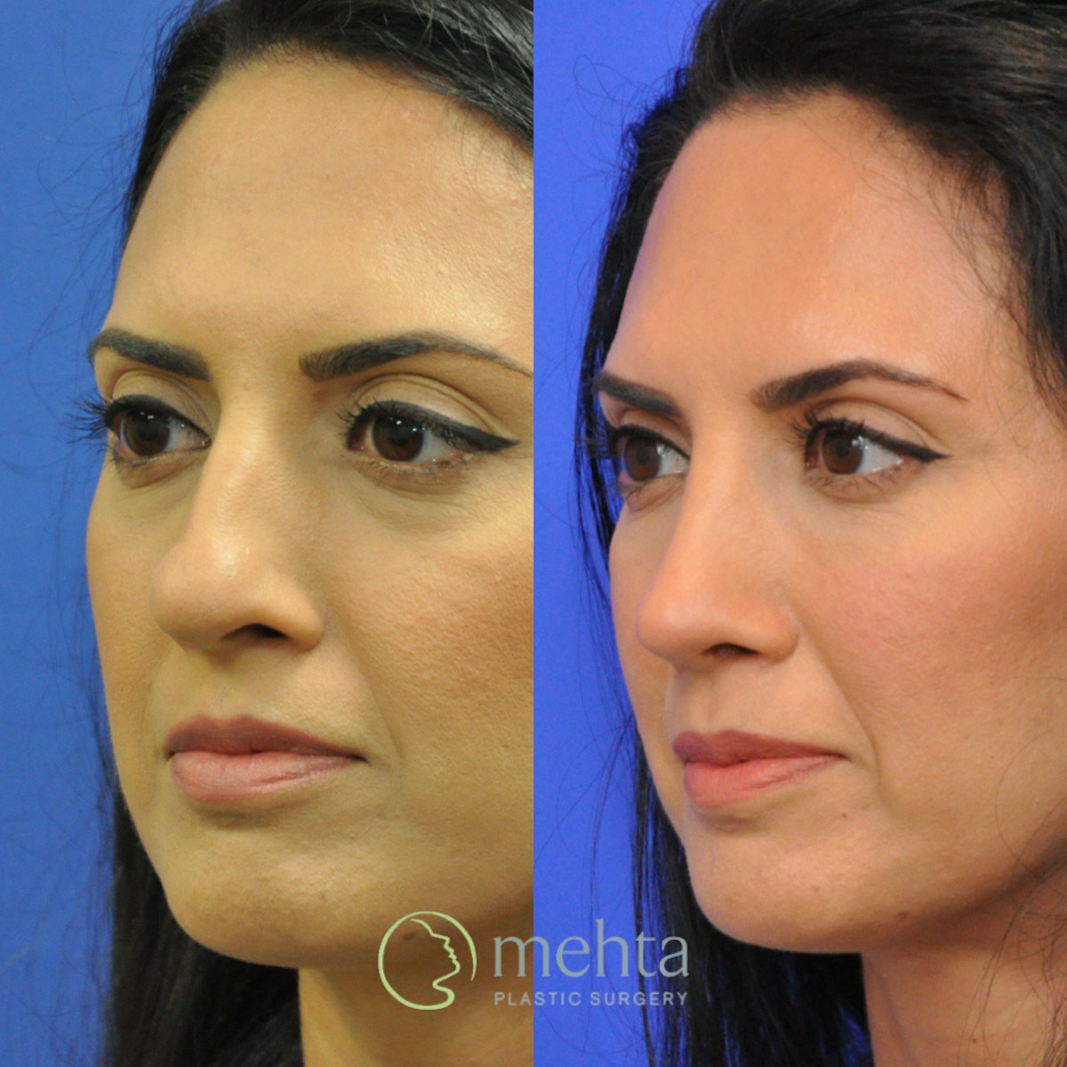 Rhinoplasty Before & After Gallery - Patient 920754 - Image 2