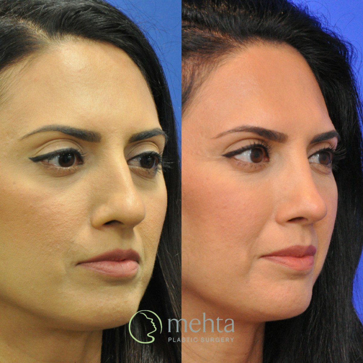 Rhinoplasty Before & After Gallery - Patient 920754 - Image 4