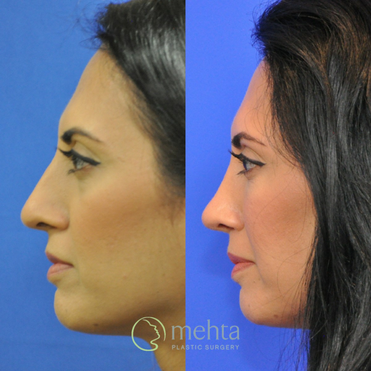 Rhinoplasty Before & After Gallery - Patient 920754 - Image 1