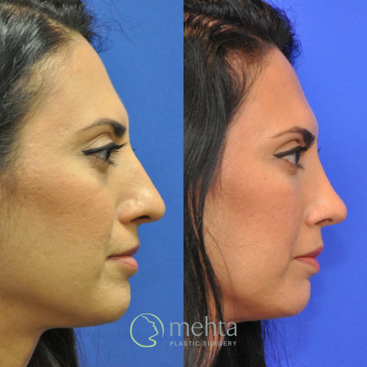 Rhinoplasty Before & After Gallery - Patient 920754 - Image 5