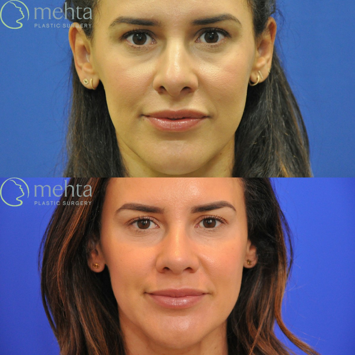 Rhinoplasty Before & After Gallery - Patient 418959 - Image 5