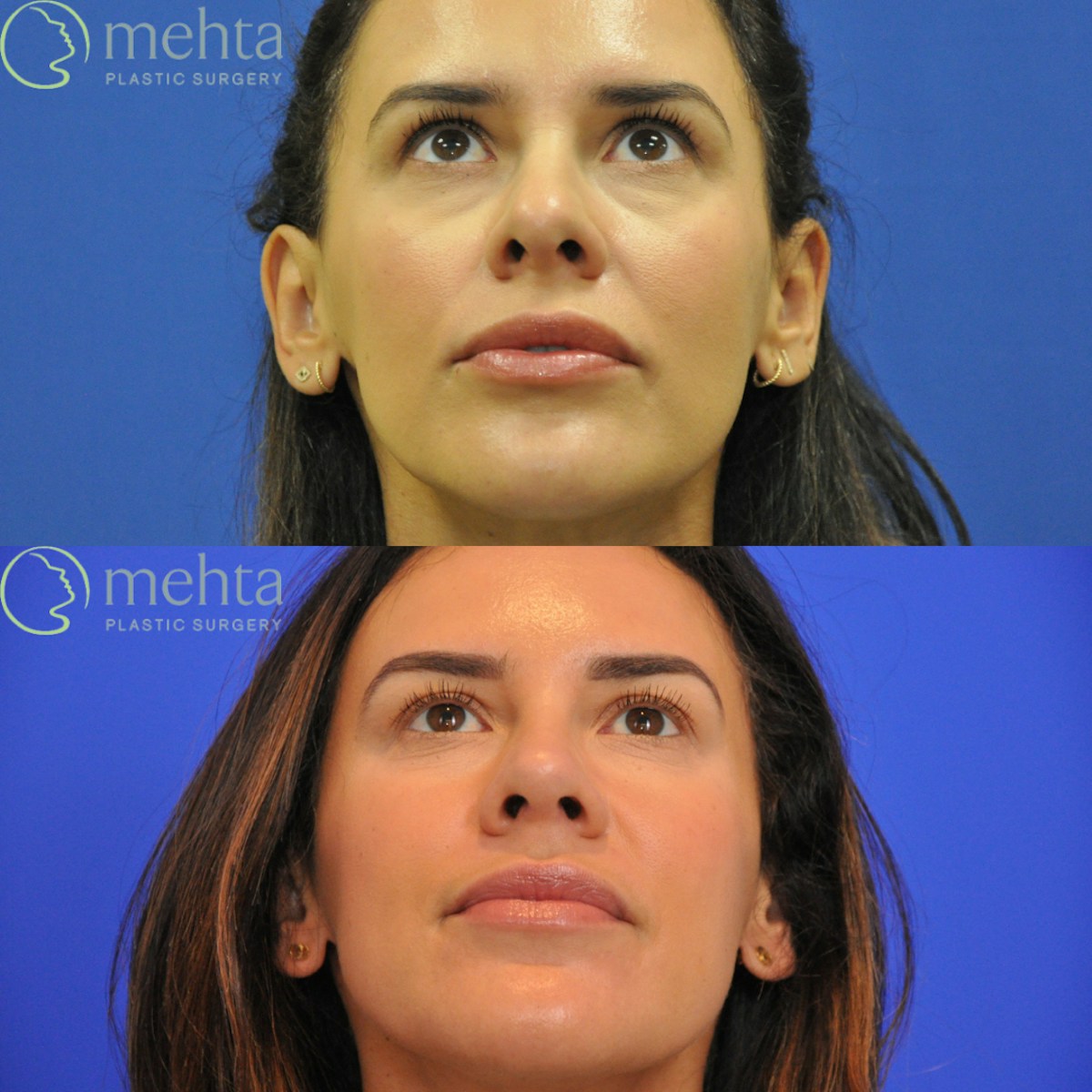 Rhinoplasty Before & After Gallery - Patient 418959 - Image 6