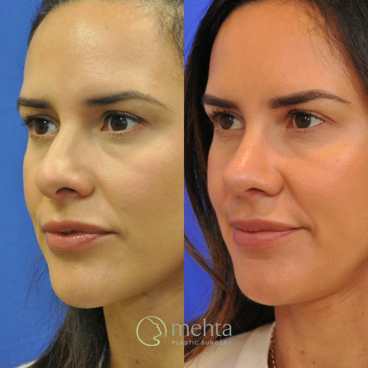 Rhinoplasty Before & After Gallery - Patient 418959 - Image 2