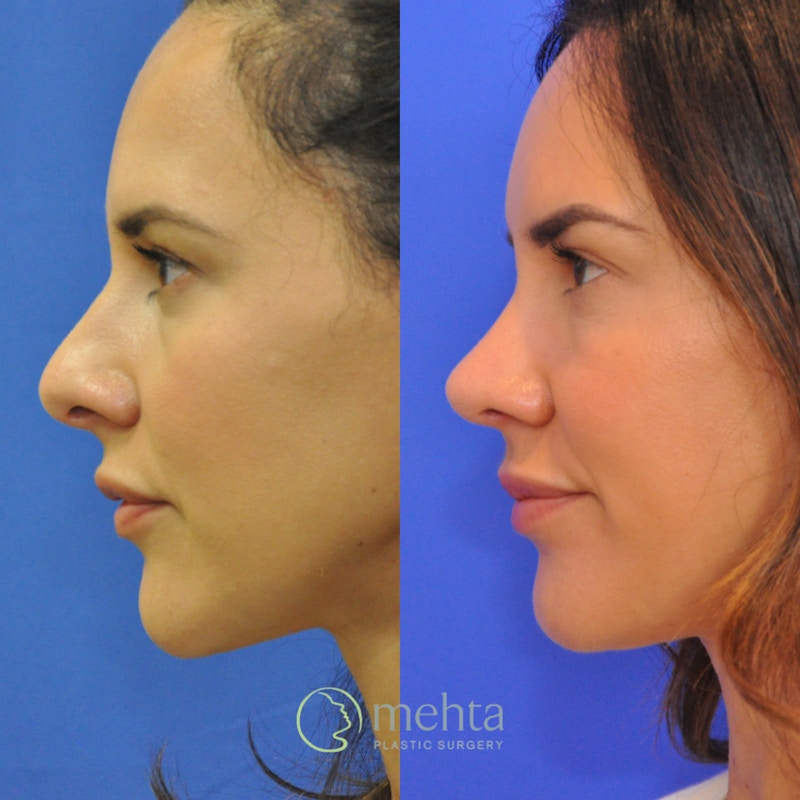 Rhinoplasty Before & After Gallery - Patient 418959 - Image 1