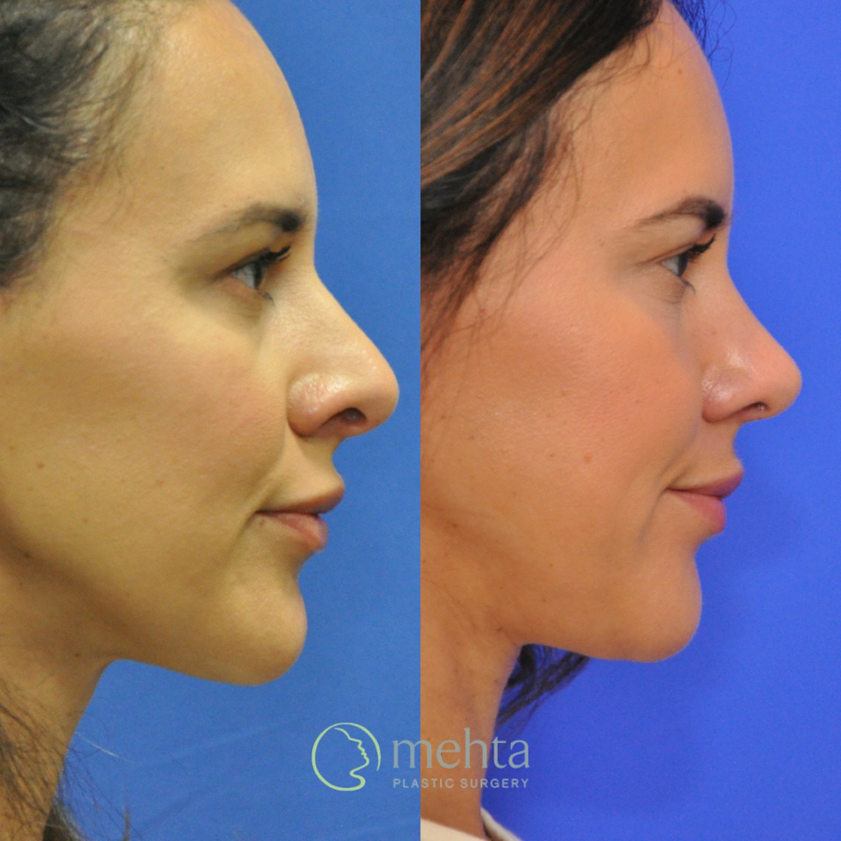 Rhinoplasty Before & After Gallery - Patient 418959 - Image 4