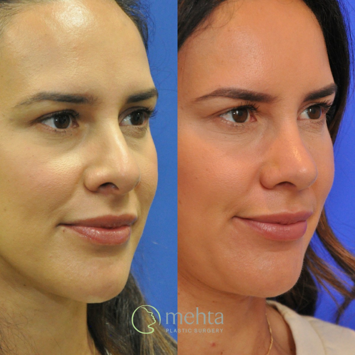 Rhinoplasty Before & After Gallery - Patient 418959 - Image 3