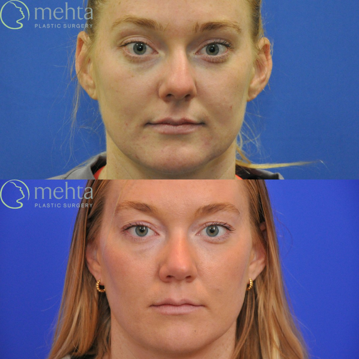 Rhinoplasty Before & After Gallery - Patient 356968 - Image 5