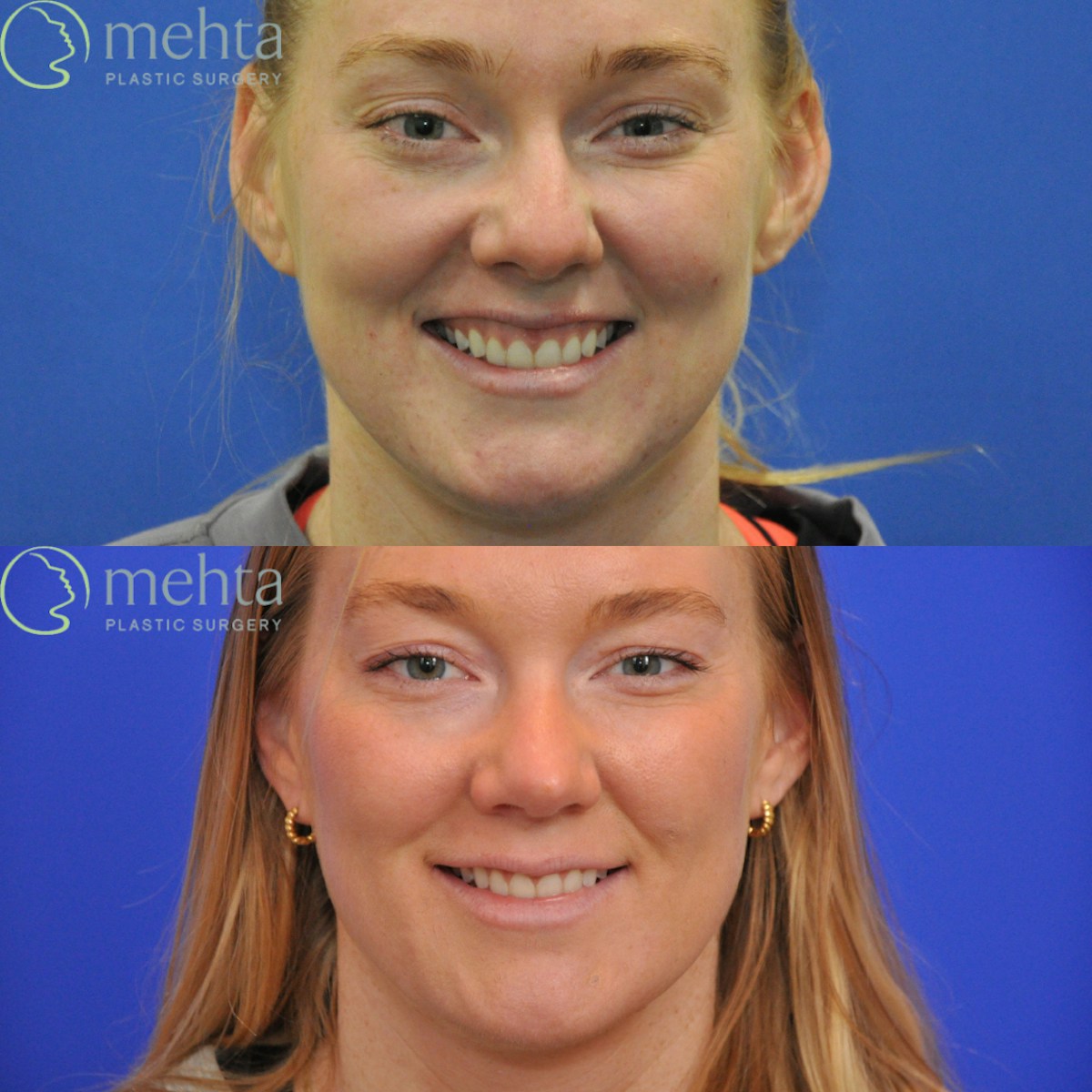 Rhinoplasty Before & After Gallery - Patient 356968 - Image 6