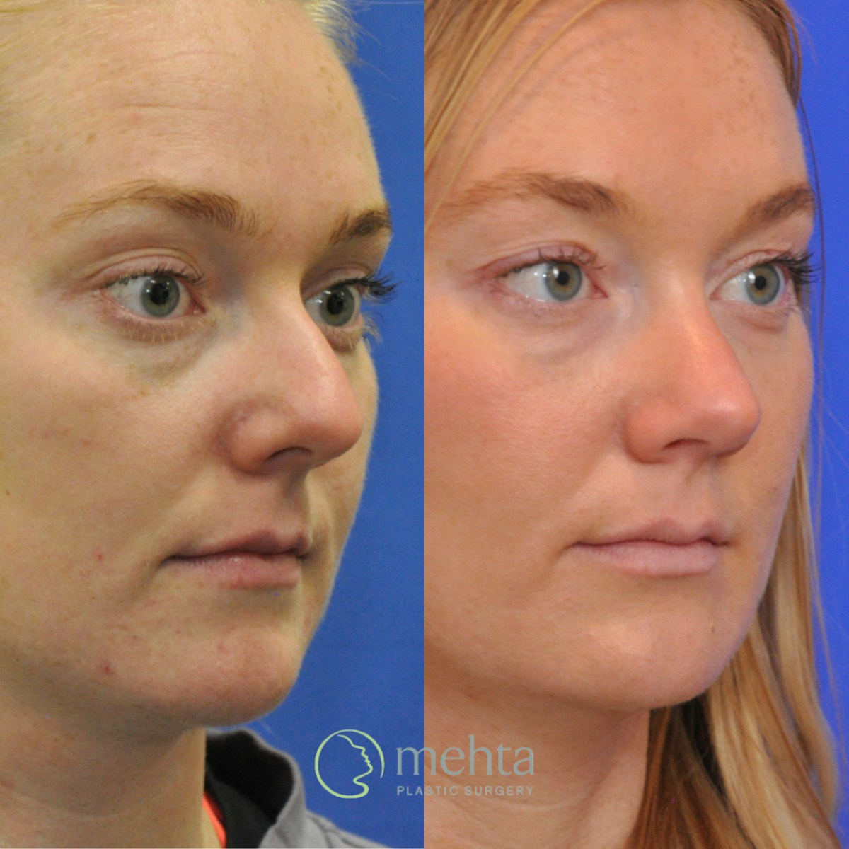 Rhinoplasty Before & After Gallery - Patient 356968 - Image 3