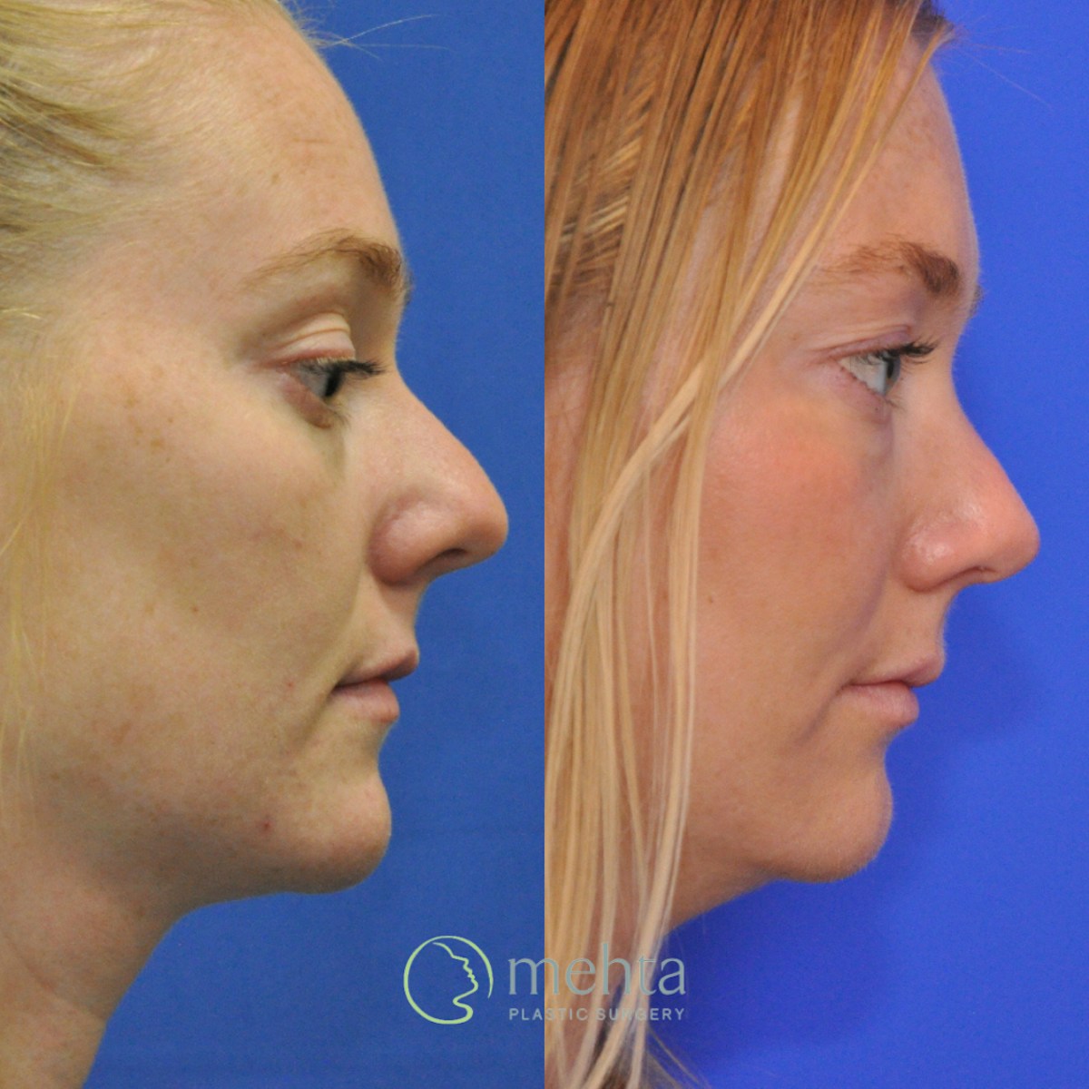 Rhinoplasty Before & After Gallery - Patient 356968 - Image 4