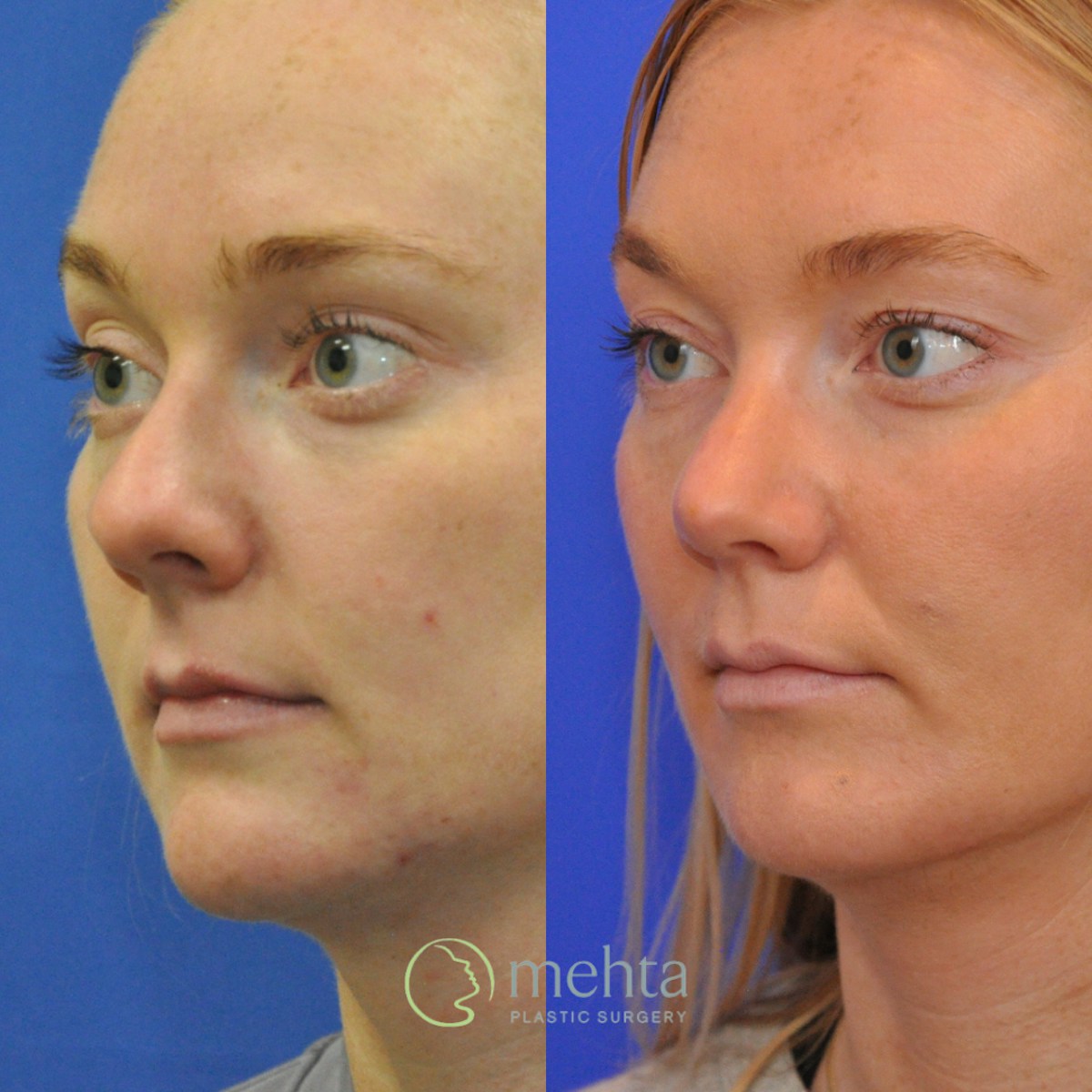 Rhinoplasty Before & After Gallery - Patient 356968 - Image 2