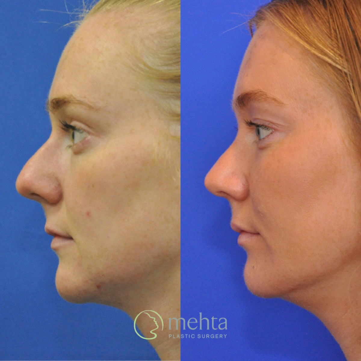 Rhinoplasty Before & After Gallery - Patient 356968 - Image 1